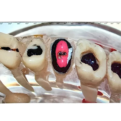 Real Picture Captured by VMS105CD Dental Microscope