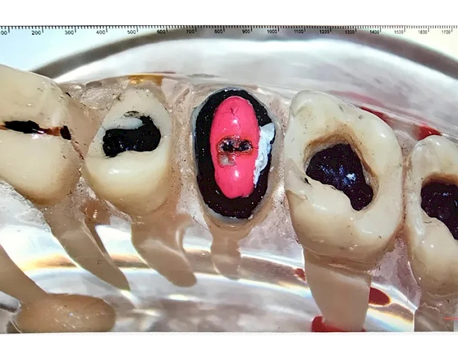 Real Picture Captured by VMS105CD Dental Microscope